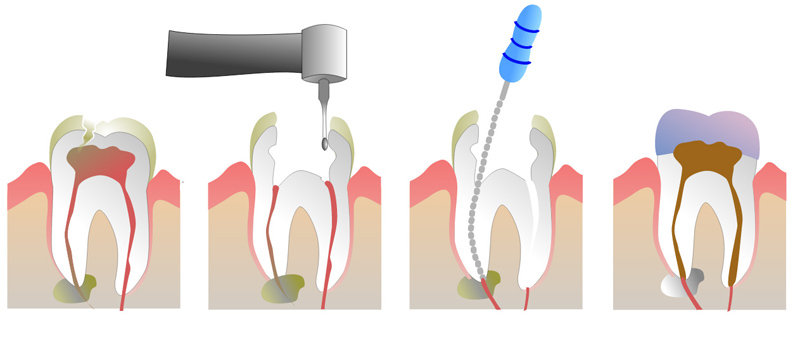 Root canal